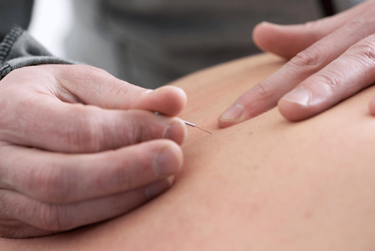Dryneedling